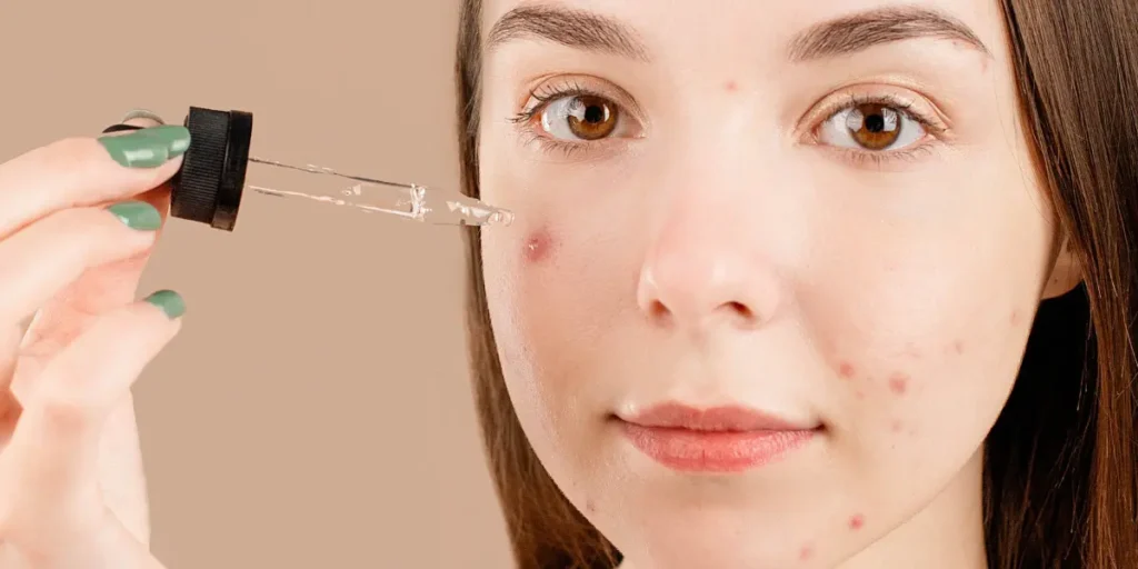 Woman with pimples on her cheeks and chin holding a dropper of clear serum near her face